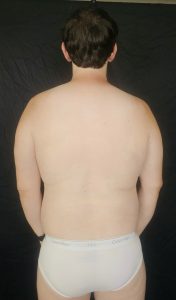 Close-up of Joshua Marron’s upper back facing backward in white briefs for Project Legacy vegan transformation progress.